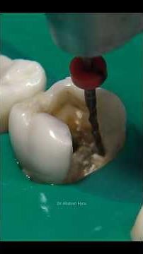 Root Canal Treatment With ROTARY ENDODONTICS #dentist #rootcanal