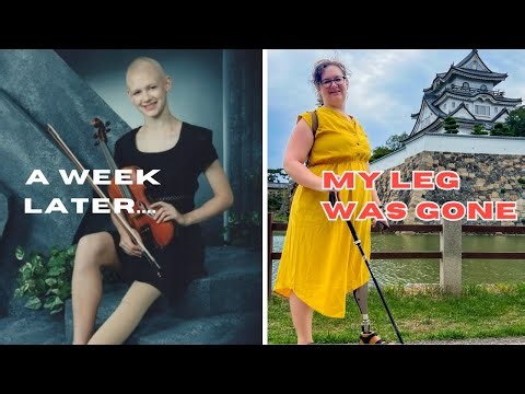 At 13, I chose to become an amputee. Here's my life 30 years later