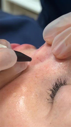 Complete Skin & Beauty on Instagram: "Diathermy is a targeted treatment used to safely remove skin lesions such as skin tags, milia, broken capillaries and small vascular spots. Using controlled heat, we treat the concern at the source with precision — minimal trauma, quick treatment time and long-term results when performed correctly. If you’ve been feeling self-conscious about a stubborn skin concern, this might be the solution you’ve been looking for 🤍 Consultation required."