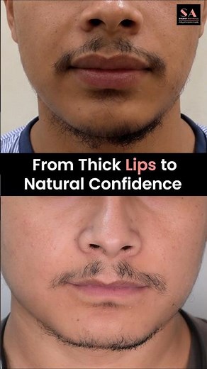 From Thick Lips to Natural Confidence | Lip Reduction Surgery Transformation