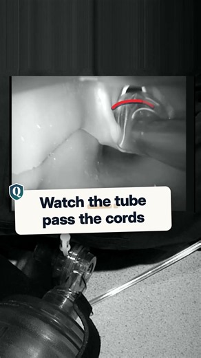 What paramedics see when a breathing tube goes in