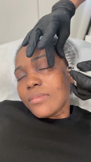 Benefits of Microdermabrasion, it offers several benefits for improving skin health and appearance. It exfoliates dead skin cells, reducing the appearance of fine lines, wrinkles, and acne scars. This process also stimulates collagen production, enhancing skin elasticity and promoting a smoother, more youthful complexion. Microdermabrasion can also minimize the appearance of enlarged pores, even skin tone, and improve overall skin texture. #dermatology #beautytips #skintightening #skinclinic #bo