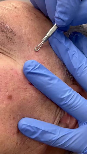Satisfying Pimple Popping Videos by Dr. Jason Chouake