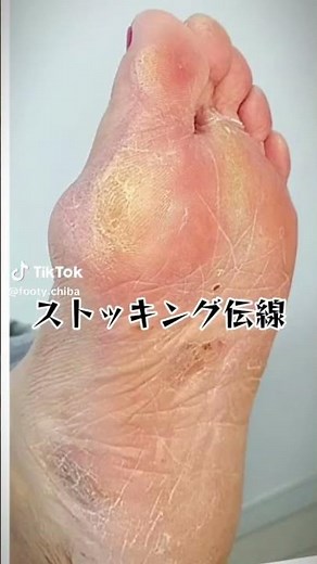 👆 足の角質専門店（@footy.horny）です👣✨⚠️デメリット5選⚠️ #角質ケア #韓国式 #フットケア #足の臭い #足の角質