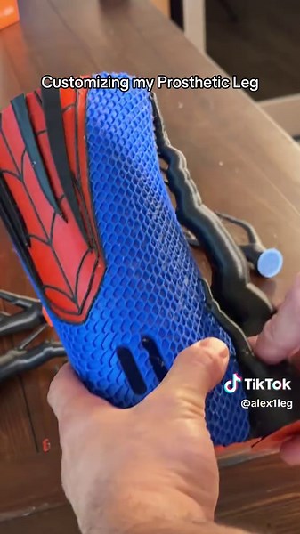 Customizing My Prosthetic Leg: A Unique Experience