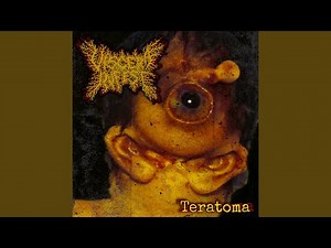 Multifocal Motor Neuropathy (MMN)