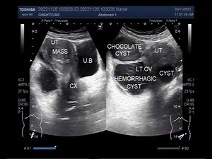 Three types of Ovarian cysts with Fibroids in the same patient.
