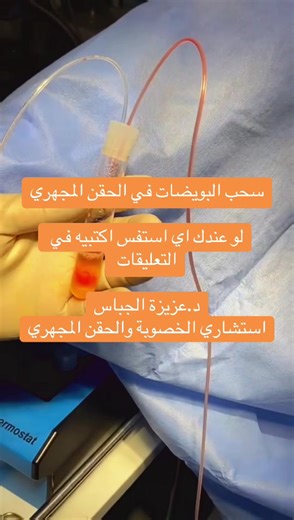 عملية سحب البويضات في الحقن المجهري؛ لو عندك اي استفسار عن الحقن المجهري اكتبيه في التعليقات وهرد عليكي. - د.عزيزة الجباس استشاري امراض النساء والخصوبة والحقن المجهري #مخزون_المبيض #تاخر_حمل #الانجاب #حقن_مجهري #دعزيزةالجباس • الحقن المجهري في رمضان 👇 @aziza el gabbas • تكلفة الحقن المجهري في مصر 👇 @aziza el gabbas تجربتي مع الحقن المجهري 👇 @aziza el gabbas