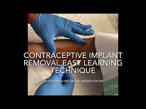 CONTRACEPTIVE IMPLANT REMOVAL. Easy learning technique