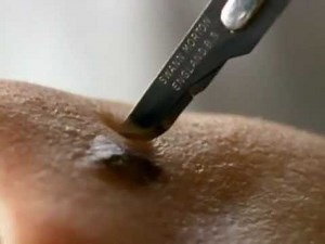 How To Remove A Skin Cancer - SunSmart Campaign (1996-1998)