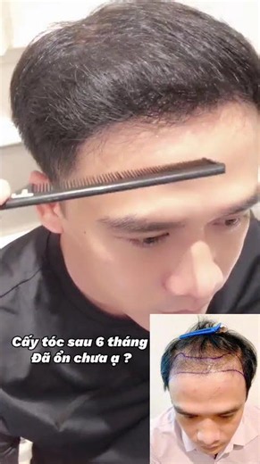 KẾT QUẢ SAU 6 THÁNG CẤY TÓC HẠ TRÁN CAO BẨM SINH
