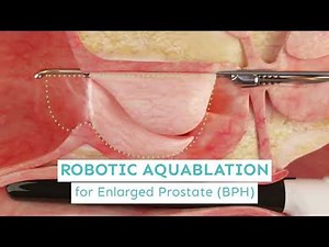Aquablation - Amazing new procedure for enlarged Prostate (Benign Prostatic Hyperplasia) Dr. Razdan