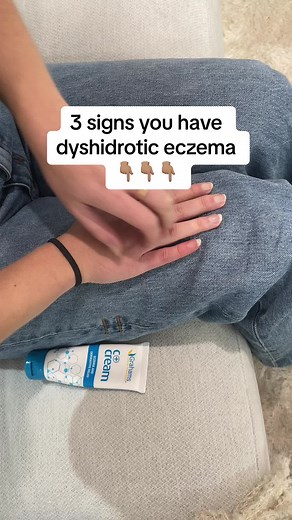Managing Dyshidrotic Eczema: Signs, Symptoms, and Solutions