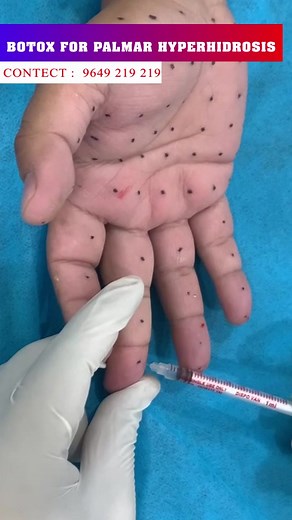 Botox for Palmar Hyperhidrosis at Skinaa Clinic #botox #botoxforhyperhidrosis #botox_palmar_hyperhidrosis #botoxpalmarhyperhidrosis #botoxforsweating #foryou #explorepage✨ #reels #reelsinstagram #skinaaclinic #skinaa_clinic #sweatingtreatment | Skinaa - Skin, Laser, and Hair Transplant Clinic