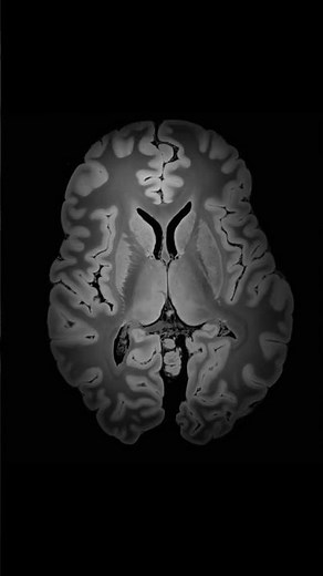 What a Human Brain Scan Looks Like