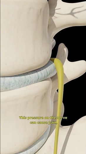 Sciatic Nerve Pain : What Causes It ?