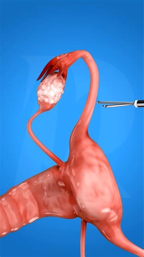 Tiny Elastic Ring That Permanently Stops Pregnancy 😱 | How It Really Works