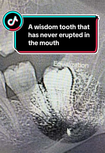 Understanding Wisdom Teeth That Never Erupt