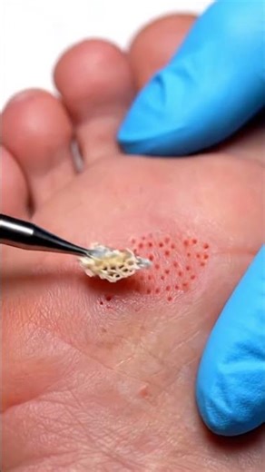 Ultra-Satisfying Foot Infection Removal ASMR | Precision Peel & Healing Clean ✨🦶