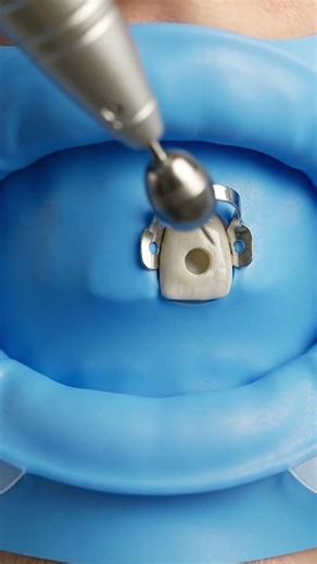 What Actually Happens During a Root Canal 🦷😱