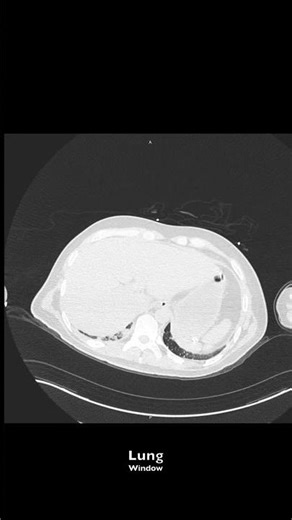 Aspergilosis Pulmonar