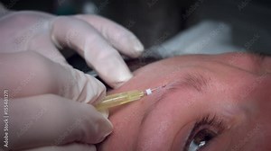 4K Doctor Applying PDO Thread Lifts in Woman Forehead