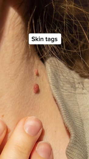 Effective Skin Tag, Ringworm, and Blackheads Treatment Methods