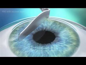 PRK Corneal Refractive Surgery Treatment Animation