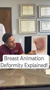 What is a Breast Animation Deformity? #breastexplant #breastimplantremoval