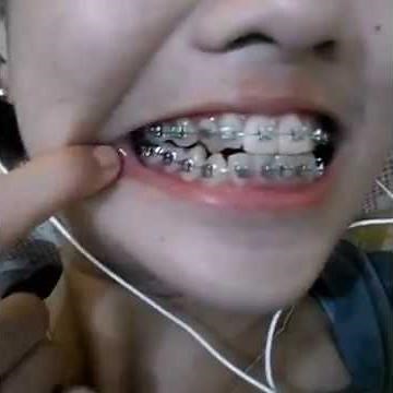 New with braces