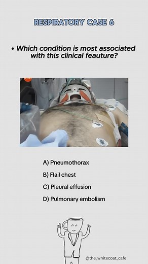 Whitecoat Café on Instagram: "Comment below👇🏽 Want to revise this topic? Comment “notes” and I’ll send you the FREE notion notes mastermind.📝 _________________________________ Answer: B (Flail chest ) Here is the explanation: Flail chest occurs when multiple consecutive ribs are fractured in at least two places, creating a free-floating segment that moves opposite to normal breathing—inward on inspiration and outward on expiration. This paradoxical movement impairs ventilation and can lead to