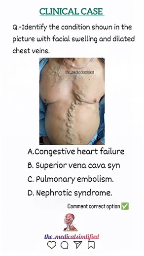 𝗧𝗵𝗲_𝗺𝗲𝗱𝗶𝗰𝗮𝗹𝘀𝗶𝗺𝗽𝗹𝗶𝗳𝗶𝗲𝗱 on Instagram: "Identify the condition shown in the picture with facial swelling and dilated chest veins. Option A) Congestive heart failure B) superior vena cava syndrome C) pulmonary embolism D) nephrotic syndrome Correct answer ✅✅ . . . . . . . . . . #fyp #doctor #futuredoctor #foryou #mbbslife #new #new #new #viral #medicalschool #medicalschool #nursing #norcet #utkarsh #concept #the_medicalsimlified #the_medicalsimlified #physics #nursingnextlive #nu