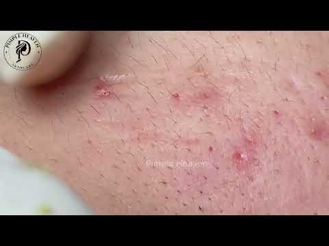 Satisfying Blackhead & Pimple Extraction ASMR — Extreme Cheek Sebum Explosion! Part 1