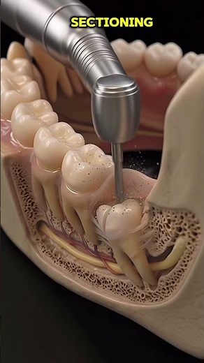 Wisdom Tooth extraction step by step | #wisdom #tooth #surgery ￼￼