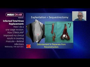 Infected Total Knee Replacement: How I do a one stage revision.