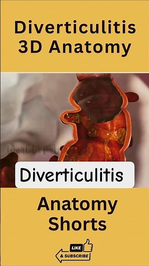 Diverticulitis in 3D 🌀 | What Happens Inside Your Colon