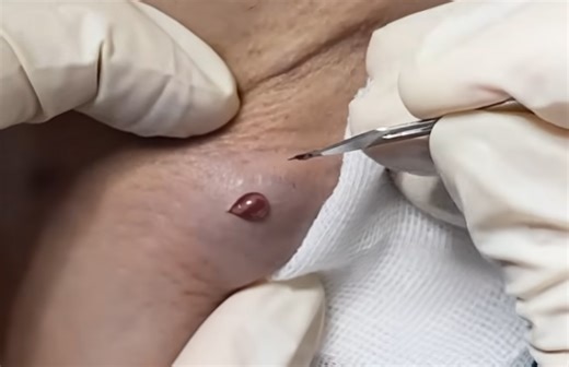 Underarm Juicy Abscess Drainage