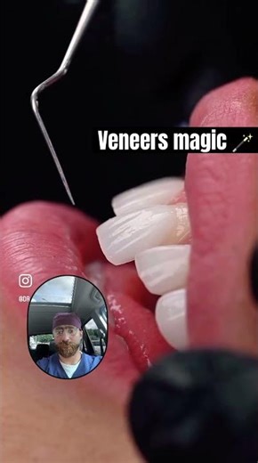 Veneers: The Secret Behind Every “Perfect” Smile 😱✨ magic 🪄