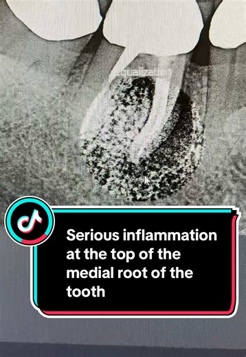 Dental Cyst: Inflammation at Tooth Root