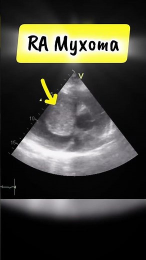 Parasternal short Axis View showing RA myxoma on Echocardiography #heart #tumor
