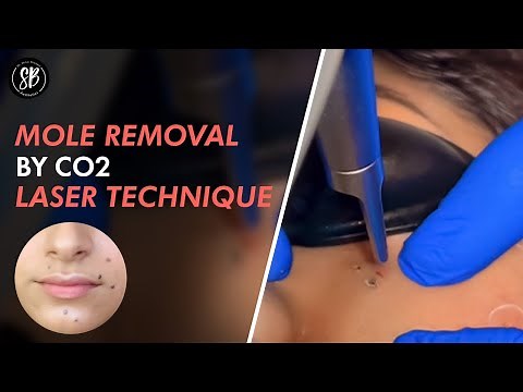 Mole Removal By CO2 Laser | Live procedure by Dr. Shilpi Bhadani | Best Cosmetic Surgeon in Gurgaon