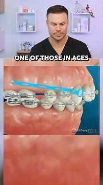 How Orthodontist Fixed Your OVERBITE! 😮🦷