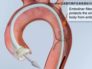 Emboliner 血管保护装置