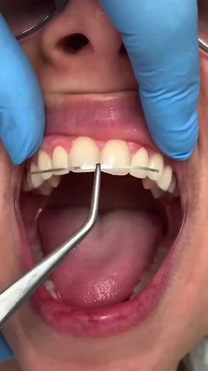 A fixed lingual retainer is used to hold the teeth connected to it in position and prevent relapse, or undesirable movement of the front teeth. Retainers are an important part of the orthodontic process and along with removable retainers – fixed retainers provide an additional layer of protection against relapse.#dentistry #Orthodontist #Braces #Retainer