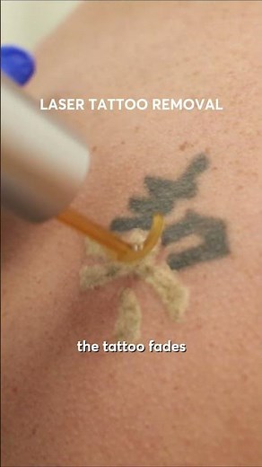 Laser Tattoo Removal Explained 🔥 Watch the Ink Disappear!