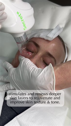 Co2 laser is excellent for skin rejuvenation and resurfacing, however it comes with risks: - Post inflammatory hyperpigmentation if skin is not prepared ( requires special cream use to stabilise pigment) - Marks that takes time to heal - Redness and sensitivity for up to few months after treatment Overall co2 results depends on the level of co2 used: - Light nano co2 peel - min to no downtime : skin rejuvenation - Mild to Mid depth co2 resurfacing - 3-5 days : addressing lines and laxity - Deep 