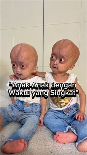 Kisah Kembar Identik dengan Progeria Syndrome | Penyakit Genetik Langka