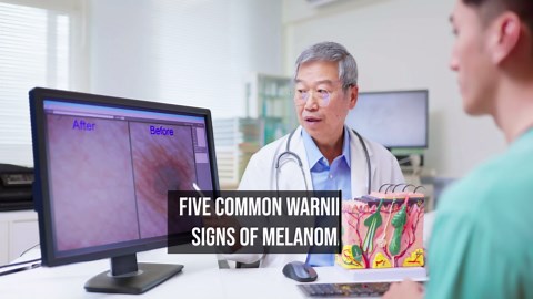 Five common warning signs of melanoma
