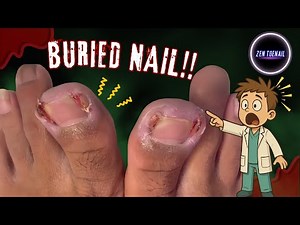 ASMR Deepest Ingrown Toenail Pulling Ever Filmed