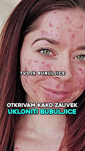 Како уклонити бубулице заувек